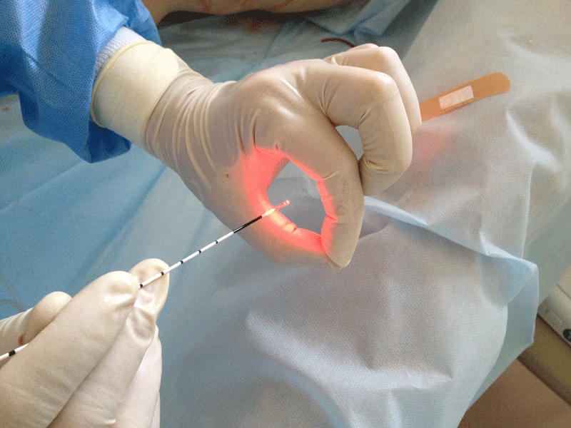 Использование лазера для лечения вен