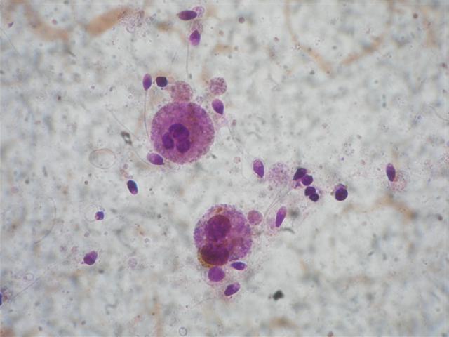 Лейкоциты в эякуляте