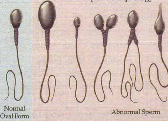 МАР-исследование спермы